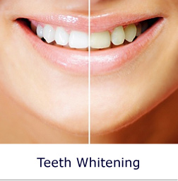 Teeth Whitening